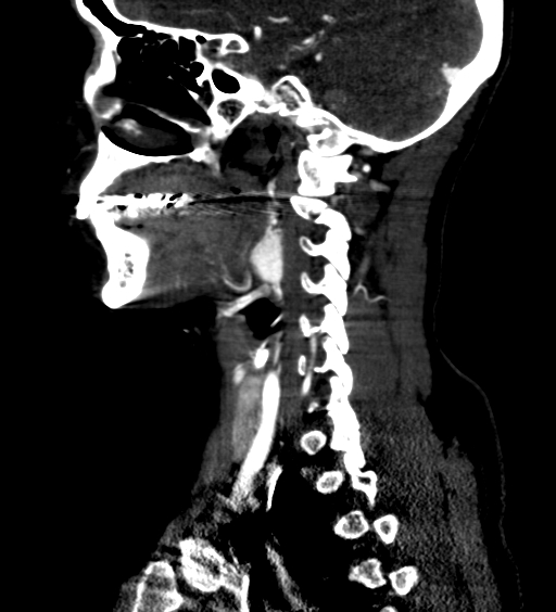 File:Carotid body tumor (Radiopaedia 39845-42300 D 55).jpg