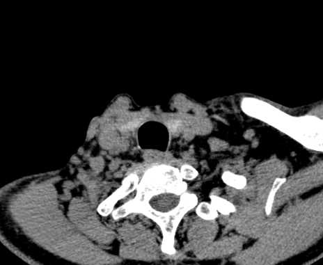 File:Carotid body tumor (Radiopaedia 61750-69757 Axial non-contrast 101).jpg