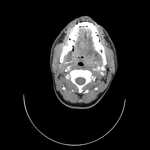 Carotid bulb pseudoaneurysm (Radiopaedia 57670-64616 A 19).jpg