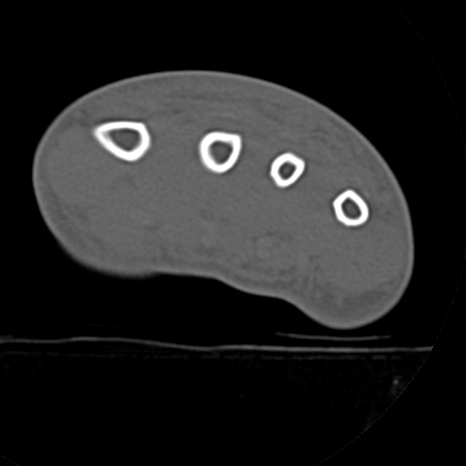 File:Carpo-metacarpal fracture-dislocations with hamatum split fracture (Radiopaedia 18482-18343 Axial bone window 1).jpg