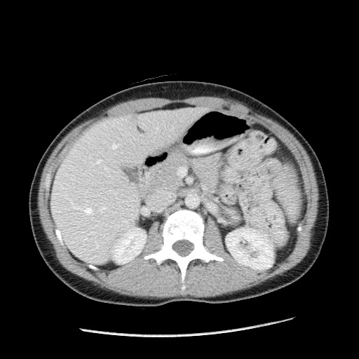 File:Castleman disease with fibrous pseudotumor in the abdomen (Radiopaedia 77296-89373 Axial 61).jpg