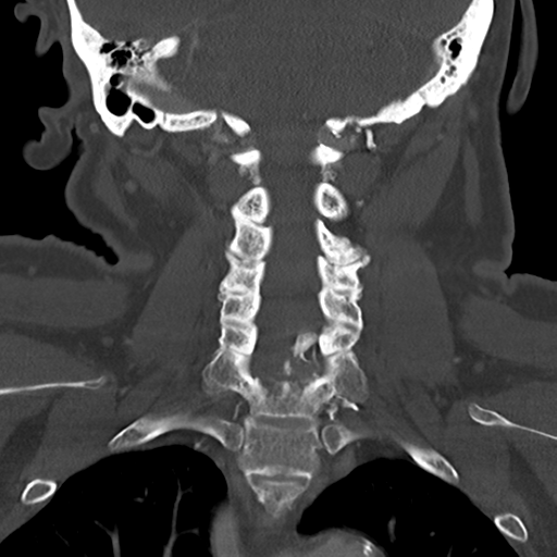 Causes of dysphagia (Radiopaedia 40149-42657 Coronal bone window 43).png