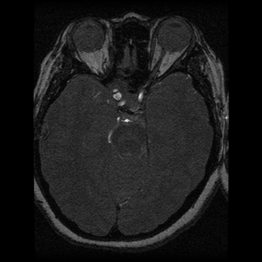Cavernoma, DVA and right ICA aneurysm (Radiopaedia 33890-35072 E 52).png