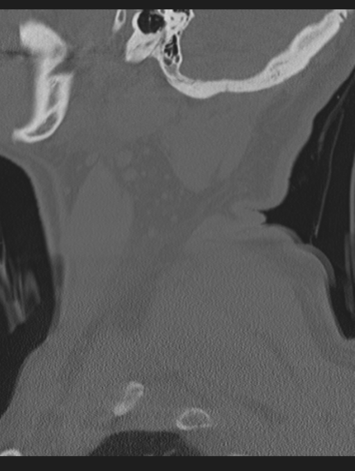 Cavernoma of cervical cord (Radiopaedia 50838-56346 Sagittal bone window 8).png