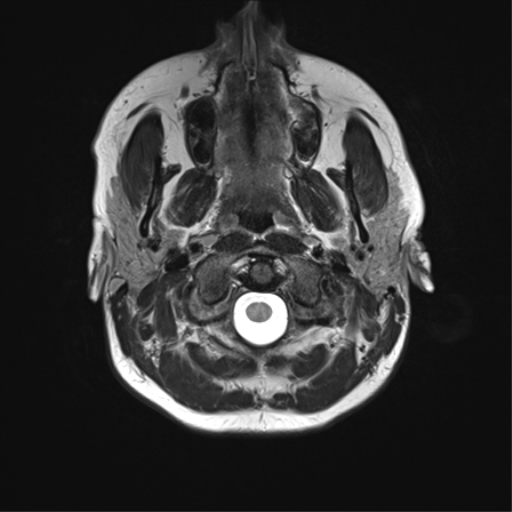 File:Cavernoma with bleed - midbrain (Radiopaedia 54546-60773 Axial T2 1).png