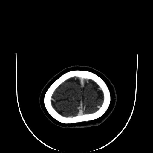 Cavernoma with developmental venous anomaly (Radiopaedia 22470-22506 C 188).jpg
