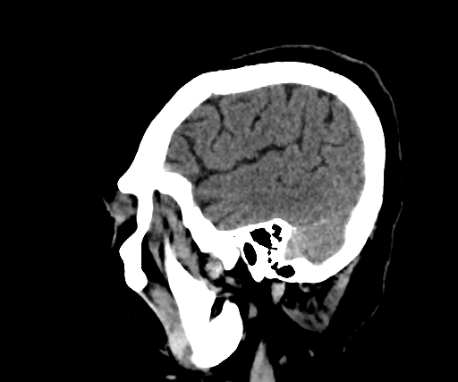 Cavernous hemangioma of the cerebellar falx (Radiopaedia 73025-83723 B 61).jpg