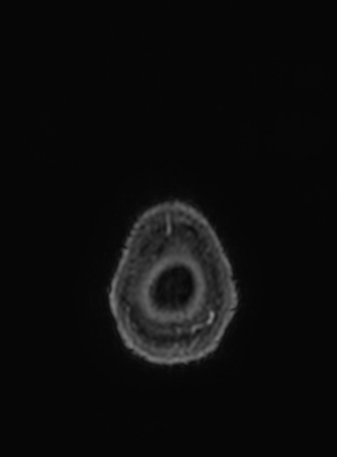 Cavernous hemangioma of the cerebellar falx (Radiopaedia 73025-83724 Axial T1 C+ 3).jpg