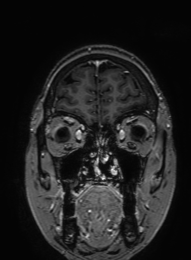 Cavernous hemangioma of the cerebellar falx (Radiopaedia 73025-83724 Coronal T1 C+ 64).jpg