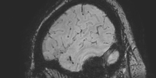 Cavernous hemangioma of the cerebellar falx (Radiopaedia 73025-83724 Sagittal BOLD 178).jpg