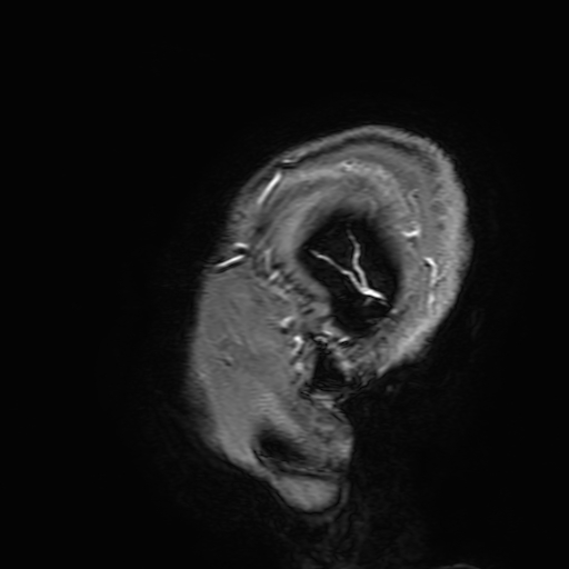 Cavernous hemangioma of the cerebellar falx (Radiopaedia 73025-83724 Sagittal T1 C+ 205).jpg