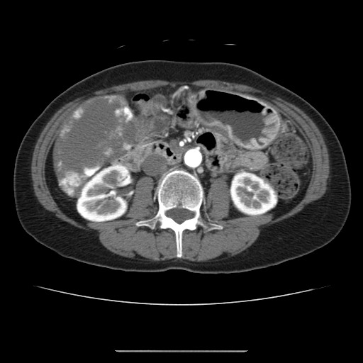 Cavernous hepatic hemangioma (Radiopaedia 75441-86667 A 55).jpg