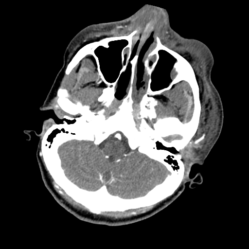 File:Cavernous sinus thrombosis (Radiopaedia 10619-11078 A 7).jpg