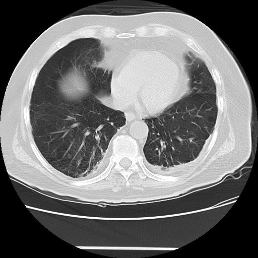 File:Cavitating pulmonary metastases (Radiopaedia 89545-106544 Axial lung window 40).jpg