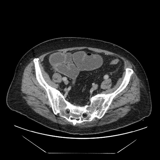 Cecal adenocarcinoma (Radiopaedia 64871-73817 A 75).jpg