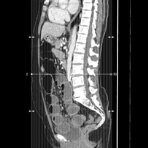 Cecal adenocarcinoma (Radiopaedia 75909-87331 B 1).jpg