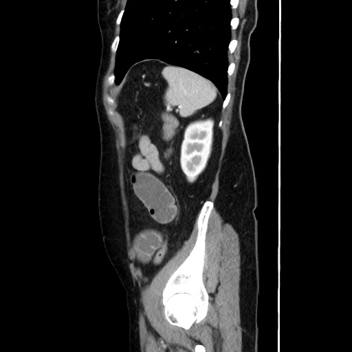 Cecal adenocarcinoma (Radiopaedia 75909-87331 C 56).jpg
