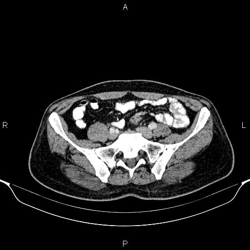 Cecal adenocarcinoma (Radiopaedia 85324-100916 B 71).jpg