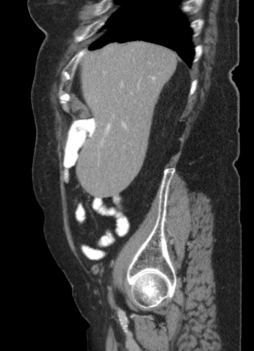 Cecal adenocarcinoma - surgical scar recurrence (Radiopaedia 79988-93264 D 51).jpg