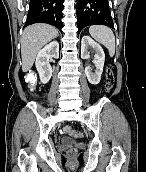 Cecal cancer with appendiceal mucocele (Radiopaedia 91080-108651 D 51).jpg
