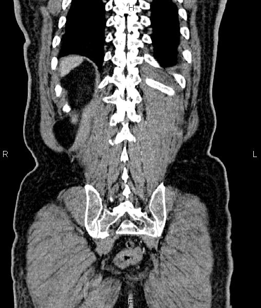 Cecal cancer with appendiceal mucocele (Radiopaedia 91080-108651 D 63).jpg