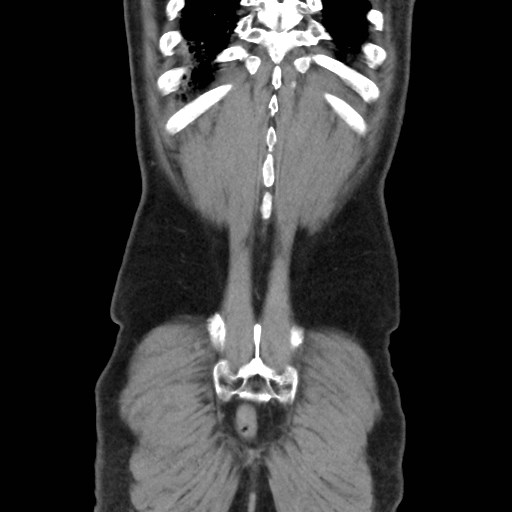 Cecal mass causing appendicitis (Radiopaedia 59207-66531 B 48).jpg