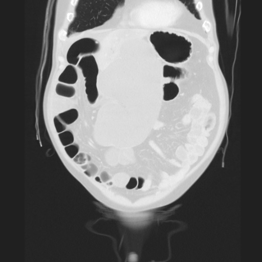 Cecal volvulus (Radiopaedia 75378-86620 Coronal lung window 44).jpg