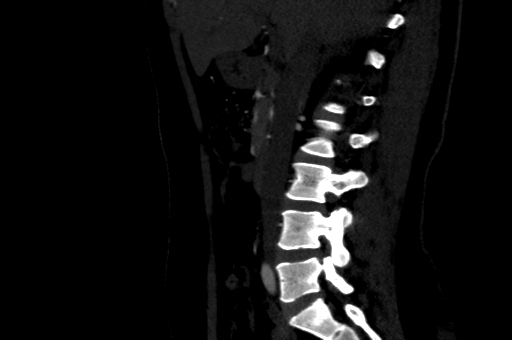File:Celiac artery compression syndrome (Radiopaedia 47538-52152 B 4).jpg