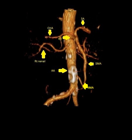File:Celiacomesenteric trunk (Radiopaedia 67660-77083 VR arterial phase 1).jpg