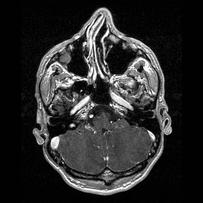Central-variant posterior reversible encephalopathy syndrome (PRES) (Radiopaedia 43880-47358 Axial T1 C+ 26).jpg