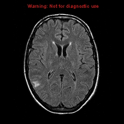File:Central nervous system vasculitis (Radiopaedia 8410-9235 Axial FLAIR 14).jpg