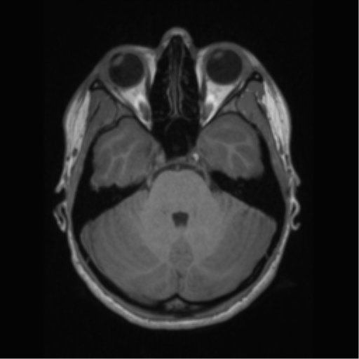 File:Central neurocytoma (Radiopaedia 37664-39557 Axial T1 20).png