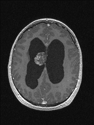 Central neurocytoma (Radiopaedia 56690-63469 Axial T1 C+ 113).jpg