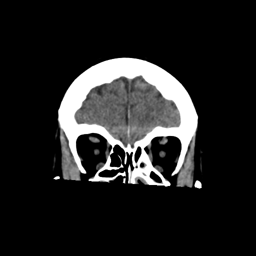 File:Central neurocytoma (Radiopaedia 65317-74346 Coronal non-contrast 13).png