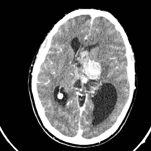 Central neurocytoma (Radiopaedia 84497-99871 B 22).jpg