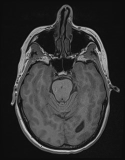 File:Central neurocytoma (Radiopaedia 84497-99872 Axial T1 70).jpg