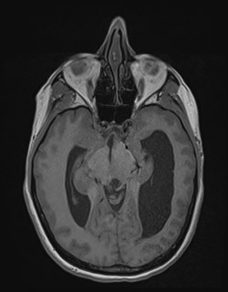 Central neurocytoma (Radiopaedia 84497-99872 Axial T1 82).jpg