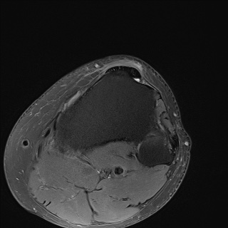 File:Central osteophyte (Radiopaedia 72592-83151 Axial PD fat sat 31).jpg