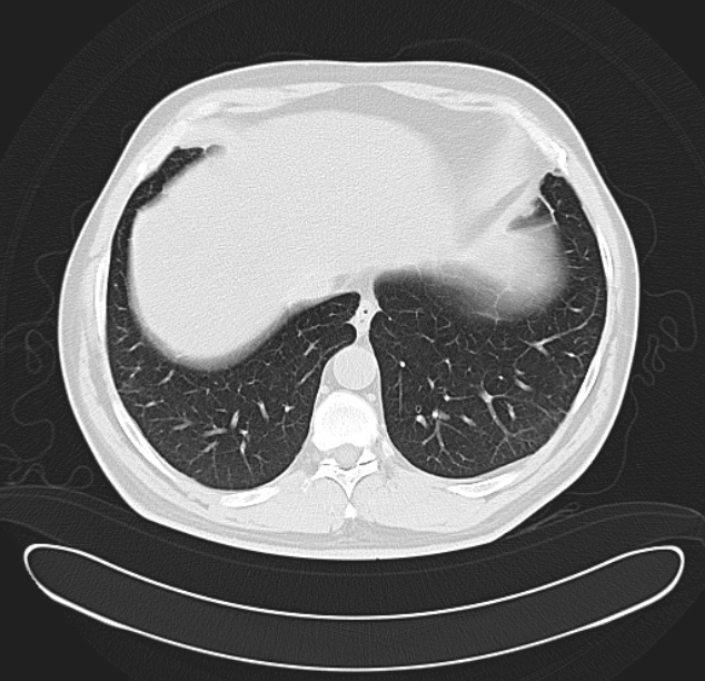 Centrilobular pulmonary emphysema (Radiopaedia 26808-26971 C 36).jpg
