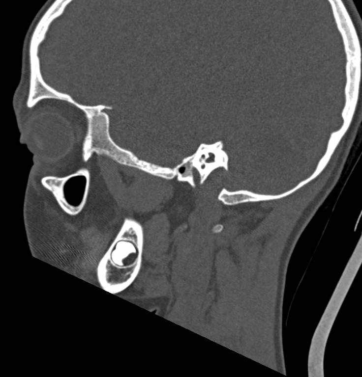 Cerebellar abscess (Radiopaedia 73727-84527 Sagittal bone window 9).jpg