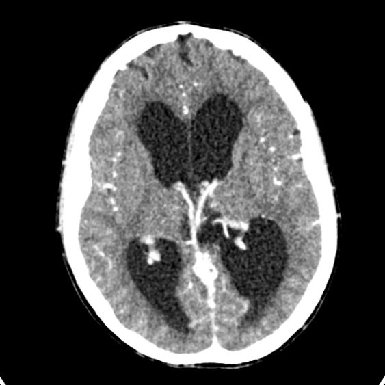 Cerebellar abscess secondary to mastoiditis (Radiopaedia 26284-26412 Axial C+ delayed 82).jpg