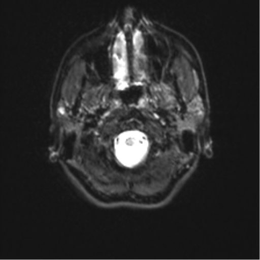 Cerebellar agenesis with hypoplastic pons (pontocerebellar hypoplasia) (Radiopaedia 57224-64138 Axial DWI 4).png