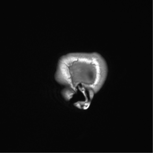 Cerebellar agenesis with hypoplastic pons (pontocerebellar hypoplasia) (Radiopaedia 57224-64138 Sagittal T1 10).png