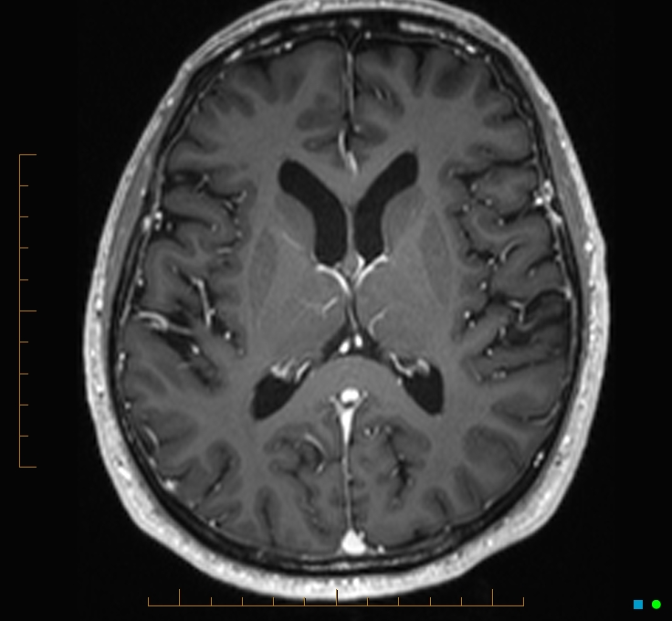 Cerebellar gangliocytoma (Radiopaedia 65377-74422 Axial T1 C+ 72).jpg