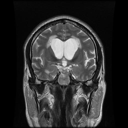 File:Cerebellar hemangioblastoma (Radiopaedia 88055-104622 Coronal T2 5).jpg