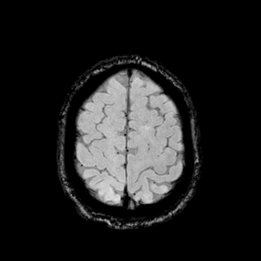 Cerebellar hemorrhage (Radiopaedia 37000-38666 Axial Gradient Echo 68).png
