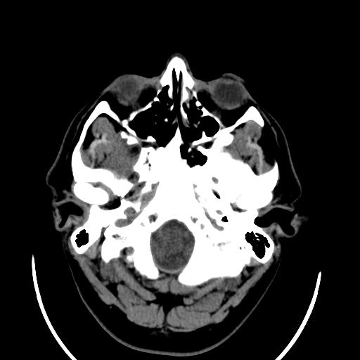 File:Cerebellar infarction (Radiopaedia 16625-16327 Axial non-contrast 6).jpg