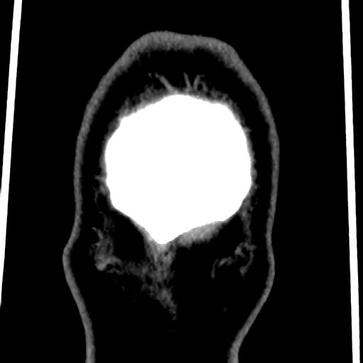 File:Cerebellar infarction (Radiopaedia 16625-16327 Coronal non-contrast 52).jpg