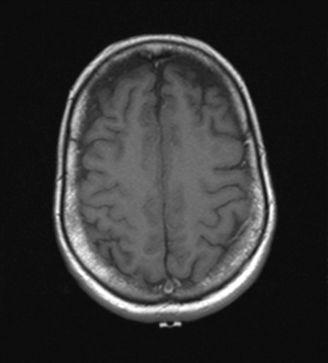 File:Cerebellar metastases (Radiopaedia 24038-24249 Axial T1 1).jpg