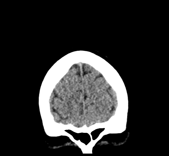 File:Cerebellar metastases - colorectal adenocarcinoma (Radiopaedia 40947-43652 Coronal non-contrast 16).png